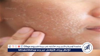 روتين العناية بالبشرة المختلطة في فصل الشتاء