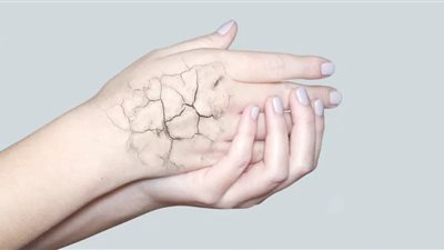 مشكلة تشقق اليدين في فصل الشتاء: الأسباب وطرق الوقاية