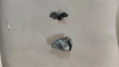  عملية جراحية دقيقة بالمستشفى الجامعيّ بأسوان لمصاب بطلق ناري في الرأس