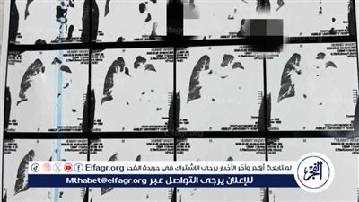 فريق جامعة أسيوط ينقذ مريضًا بعيب صدرى نادر
