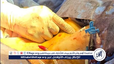صحة الدقهلية:نجاح فريق طبي مشترك في إنقاذ حياة مرض يعانى قطع فى الشريان الكبدى الأيمن