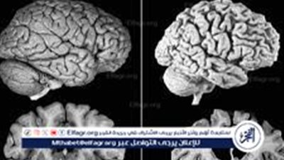دراسة جديدة تظهر فعالية دواء تجريبي في علاج مرض ألزهايمر
