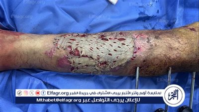 صحة الدقهلية: نجاح عملية ترقيع جلدي للساق بعد تركيب مثبت خارجي بمستشفى السنبلاوين 