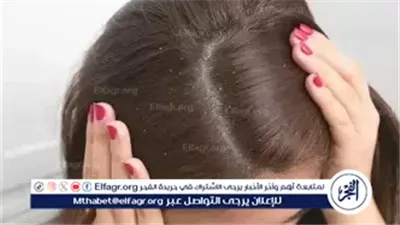 حلول طبيعية للتخلص من قشرة الشعر في الصيف