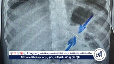 قسم الجراحة..ينجح فى استخراج دبوس من معدة صغير بسوهاج