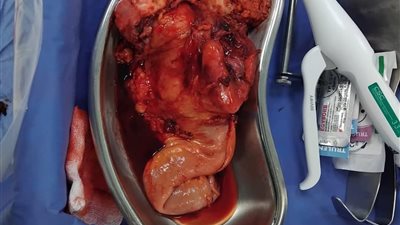 استئصال ورم بالقولون لمريض سبعيني في جراحة دقيقة بمستشفى «التأمين الصحى» بطنطا