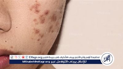 كيفية التخلص من آثار الحبوب.. مشكلة تؤرق الكثيرين