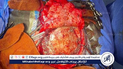 وكيل صحة الدقهلية: نجاح جراحة دقيقة لزرع عظام الجمجمة بمستشفى السنبلاوين