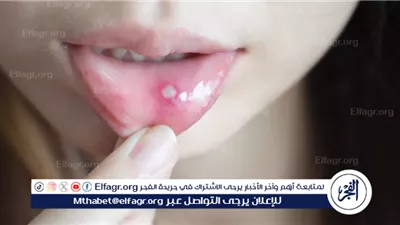لماذا تظهر حبة بيضاء في اللثة؟ الأسباب وطرق التعامل