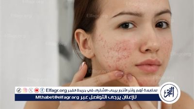 الشمس عدو خفي للبشرة الدهنية الحساسة.. تفاصيل 