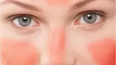 البشرة الدهنية الحساسة تحت التهديد.. أشعة الشمس سلاح صامت يُهاجم وجهكِ في الصيف