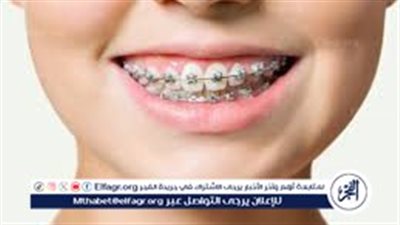 طبيبة أسنان: مرحلة المراهقة الأفضل لتركيب التقويم.. ونحذر من 
