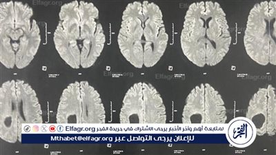 مستشفى سوهاج الجامعى:نجاح جراحة ميكروسكوبية دقيقة لاستئصال ورم بالمخ 