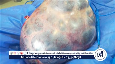 وكيل وزارة الصحة بالفيوم يعلن نجاح مستشفى ابشواى فى استخراج ورم من بطن مريضة يزن 7 كيلو 