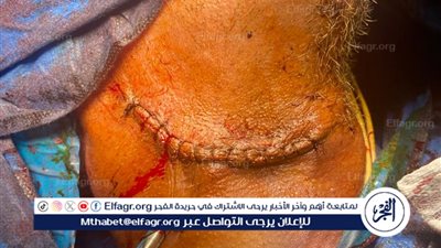 فريق طبي بجامعة أسيوط ينقذ حياة مريض مسن أصيب بجرح نافذ في الرقبة نتج عنه تهتك بالشرايين