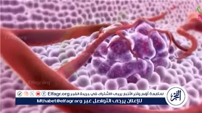 هل يوجد أعراض لفيروس سرطان عنق الرحم؟.. طبيب يوضح