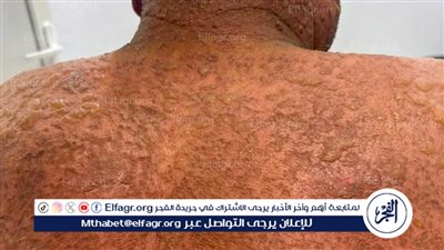 إنقاذ مريض ستيني مصاب بمتلازمة ستيفنز جونسون في مستشفى المنصورة الدولي