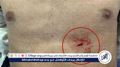 فريق طبي بمستشفى المنصورة الدولي ينقذ شابًا من موت محقق بعد طعنة مباشرة في القلب