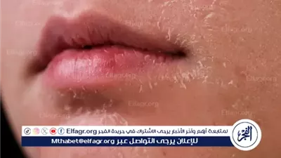 جفاف البشرة.. أزمة تجميلية يمكن السيطرة عليها