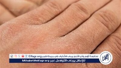 جفاف الجلد.. مشكلة شائعة وحلول فعّالة لاستعادة النعومة
