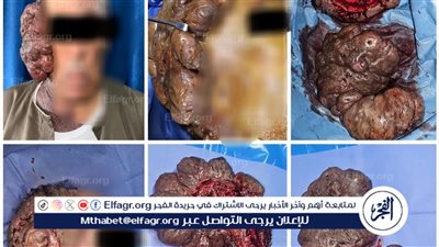 فريق طبي بجامعة أسيوط ينجح في إجراء جراحة نادرة لاستئصال ورم ضخم بالوجه لمريض