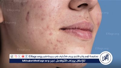 البشرة الدهنية.. بين المشاكل والحلول