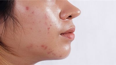 العناية بالبشرة الدهنية… خطوات فعّالة للتحكم في الزيوت والوقاية من الحبوب