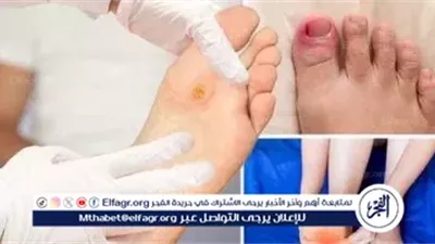 مرض اليد والقدم والفم عند البالغين (HFMD): كل ما تحتاج معرفته