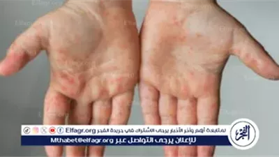 وزارة الصحة تطمئن أولياء الأمور: مرض اليد والقدم والفم شائع وبسيط ولا يستدعي القلق
