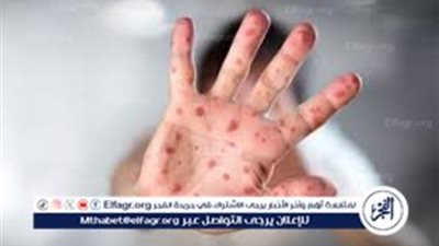 عاجل - حقيقة إغلاق المدارس والإجراءات الوقائية.. رسالة عاجلة من الصحة بشأن ظهور HFMD بين الطلاب