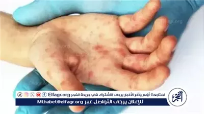 عاجل- الصحة تطمئن أولياء الأمور: لا داعي لإغلاق المدارس بسبب فيروس HFMD والإصابات بسيطة