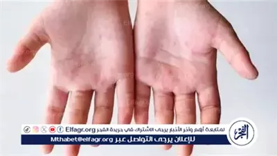 عاجل- تعليم الجيزة: فتح فصل حالات الإصابة بفيروس HFMD الأحد المقبل بعد استكمال التعقيم