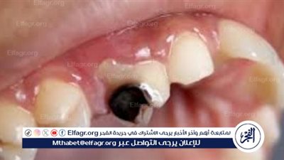 تأثير مرض السكري على الأسنان: مشكلات صامتة تهدد الابتسامة