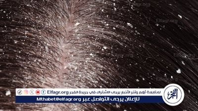 القشرة.. العدو الخفي لفروة الرأس وطرق التخلص منها نهائيًا