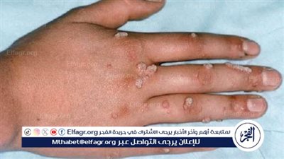 استشاري مناعة: الخريف أخطر فصول العام من حيث العدوى الفيروسية.. واللقاحات خط الدفاع الأول