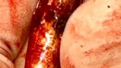 إنجاز طبي نادر بجامعة الإسكندرية لإنقاذ مصاب فلسطيني من غزة