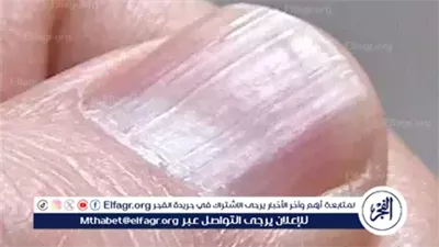 علامات على الأظافر تكشف عن حالات صحية خطيرة.. لا تتجاهلها 