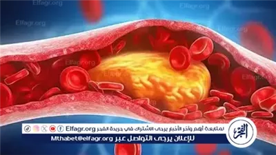 5 علامات تحذيرية و5 أسباب تؤدي لارتفاع الكوليسترول في الجسم