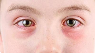 مصر تعلن خلوها من مرض التراكوما.. فما تعرف عنه؟