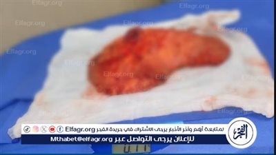 6 أطباء و3 تخصصات و8 ساعات جراحية: إنجاز طبي كبير لجامعة بني سويف في إعادة بناء الثدي بتقنية متقدمة