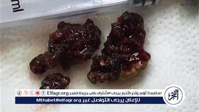 إنقاذ نادر في مستشفى الواسطي: استخراج حصوة من أنف مريضة لأول مرة بالمنظار ببني سويف 