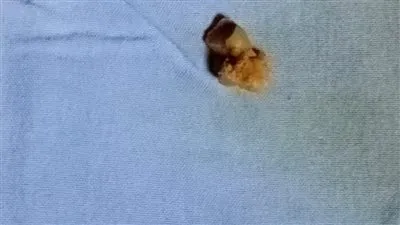 نجاح أول عملية لاستخراج حصوات بالقناة المرارية باستخدام ERCP داخل مستشفيات صحة الدقهلية