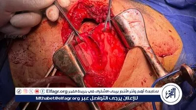عملية دقيقة لفريق تنقذ شابًا من جروح نافذة في القلب والرئة بمستشفى سوهاج