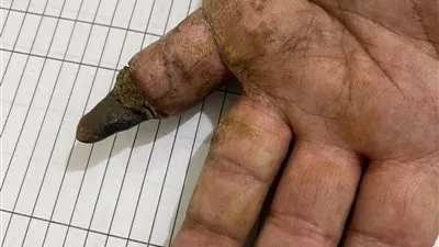 صحة الدقهلية: مستشفى السنبلاوين تُجري 6 عمليات جراحة تجميل دقيقة لحالات معقدة