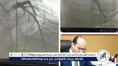 إجراء قسطرة وإزالة جلطة قلبية بمستشفى ميت غمر بعد تحويل المريضة من دكرنس