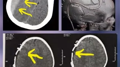 نجاح طبي عاجل.. إنقاذ طفل بعد حادث مروع بمستشفى كفر شكر التخصصي