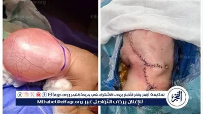 فريق طبي بجامعة أسيوط ينجح في إجراء جراحة دقيقة لاستئصال كيس سحائي وإصلاح عيوب خلقية معقدة لرضيع 