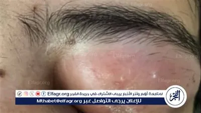فريق طبي بأزهر أسيوط يعيد الرؤية لمريضة بعد استخراج جسم زجاجي أسفل العين بعد عشر سنوات 