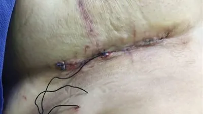 جراحة قلب دقيقة بالتدخل المحدود في مستشفيات جامعة بني سويف تُعيد مريضًا إلى حياته الطبيعية خلال أسبوعين