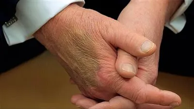 لأول مرة.. ترامب يكشف سبب الكدمات على يديه